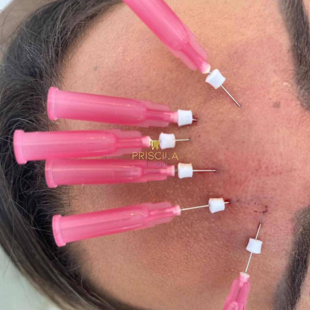 Dra. Priscila Persoli Fios de PDO #1.E